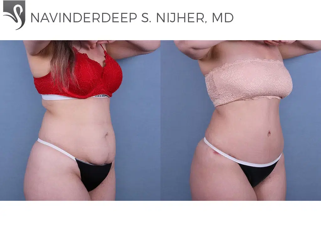 Before and After Image: Abdominoplasty (Tummy Tuck) Case #64393 - right-front-oblique