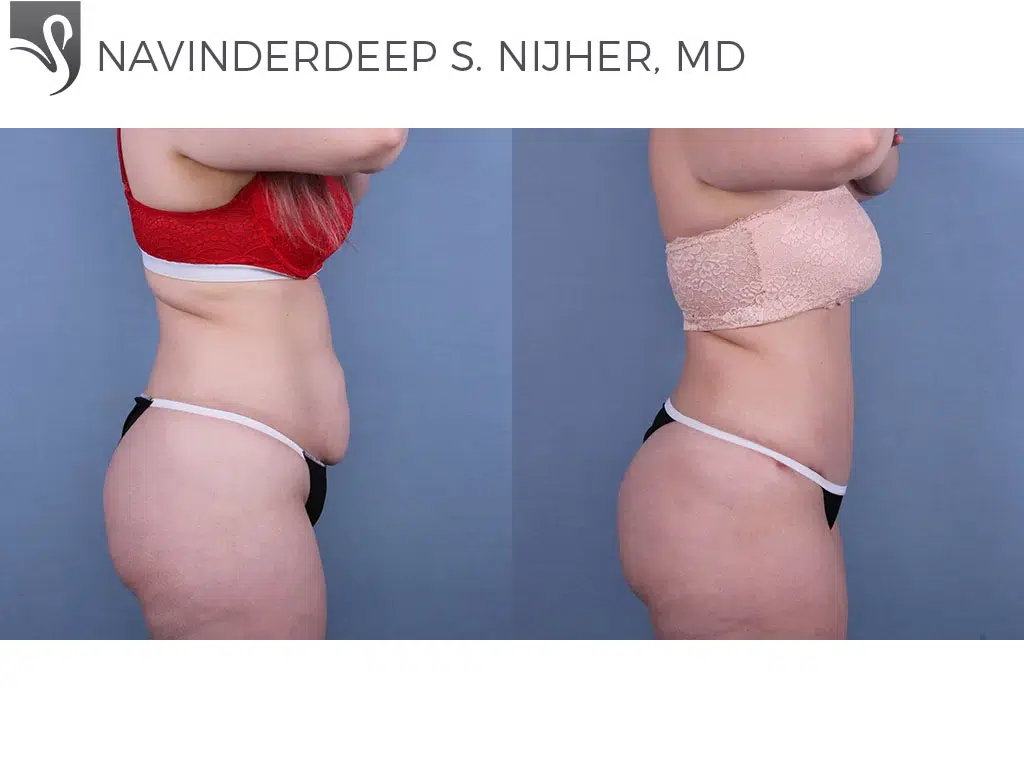 Before and After Image: Abdominoplasty (Tummy Tuck) Case #64393 - right-side