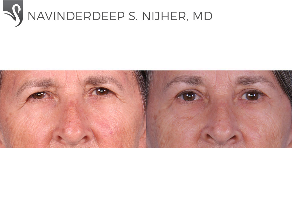 Before and After Image: Eyelid Surgery Case #64411 - front