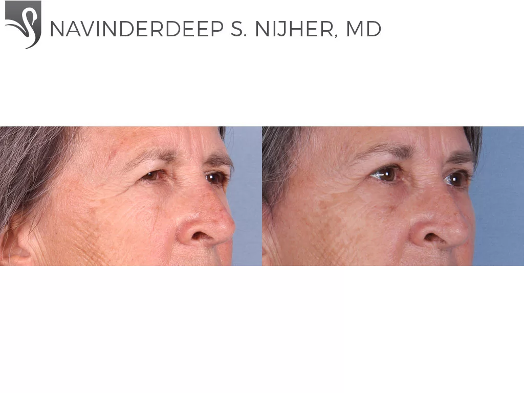 Before and After Image: Eyelid Surgery Case #64411 - right-front-oblique