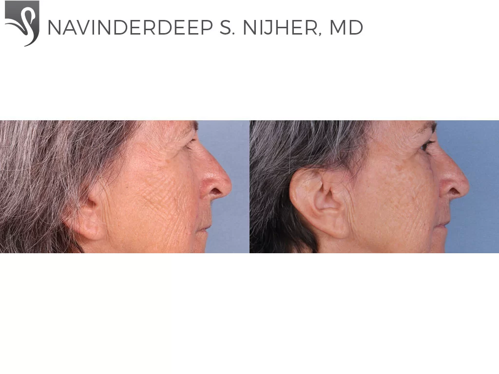 Before and After Image: Eyelid Surgery Case #64411 - right-side