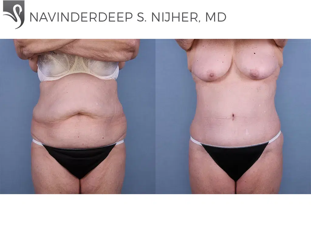 Before and After Image: Abdominoplasty (Tummy Tuck) Case #64697 - front