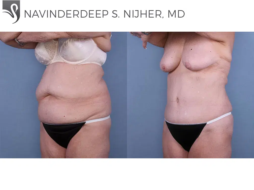 Before and After Image: Abdominoplasty (Tummy Tuck) Case #64697 - left-front-oblique