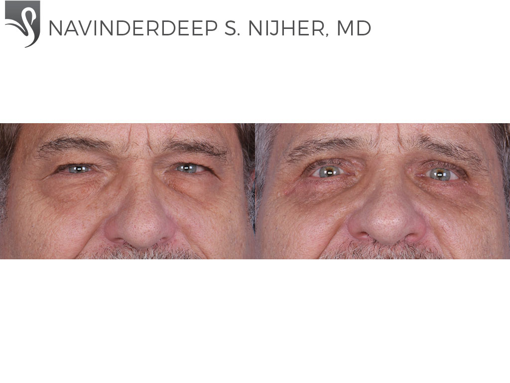 Before and After Image: Eyelid Surgery Case #64737 - front