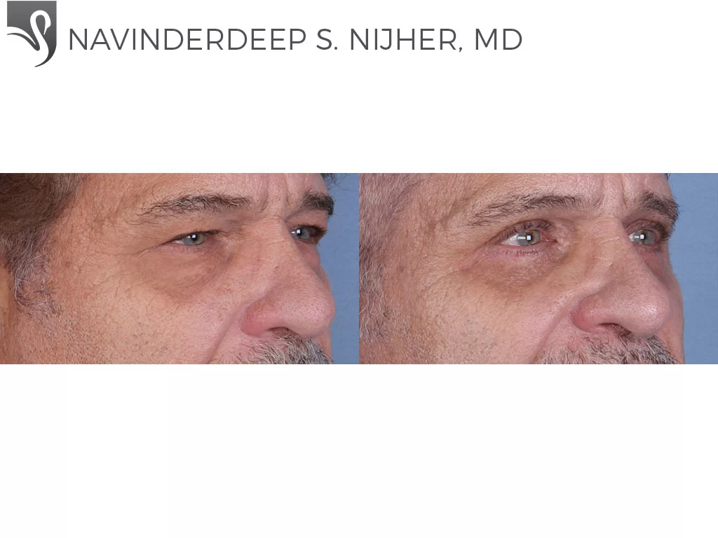 Before and After Image: Eyelid Surgery Case #64737 - right-front-oblique