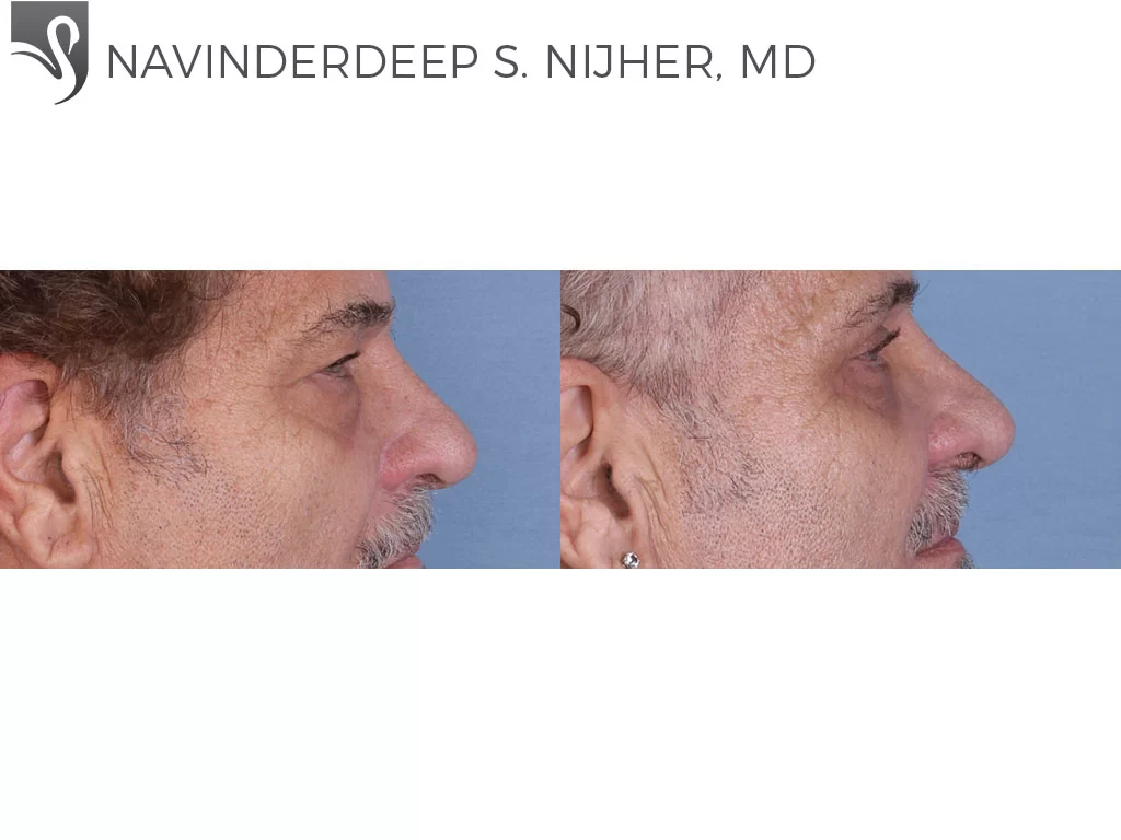 Before and After Image: Eyelid Surgery Case #64737 - right-side