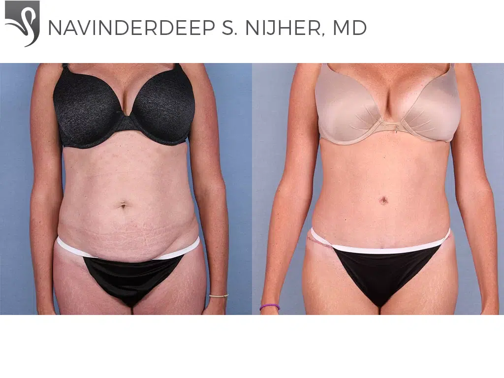 Before and After Image: Abdominoplasty (Tummy Tuck) Case #64757 - front