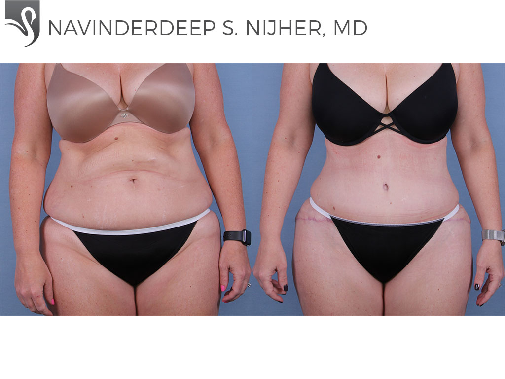 Before and After Image: Abdominoplasty (Tummy Tuck) Case #64777 - front