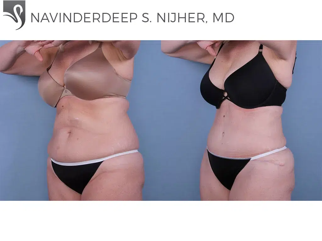 Before and After Image: Abdominoplasty (Tummy Tuck) Case #64777 - left-front-oblique