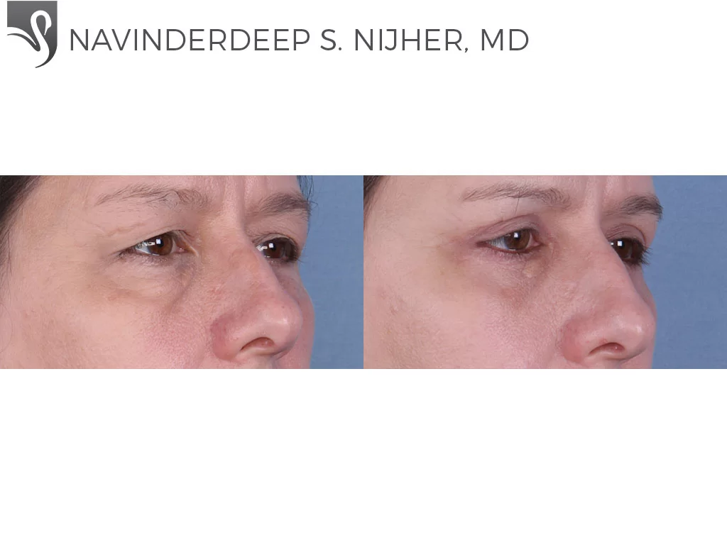 Before and After Image: Eyelid Surgery Case #65236 - right-front-oblique