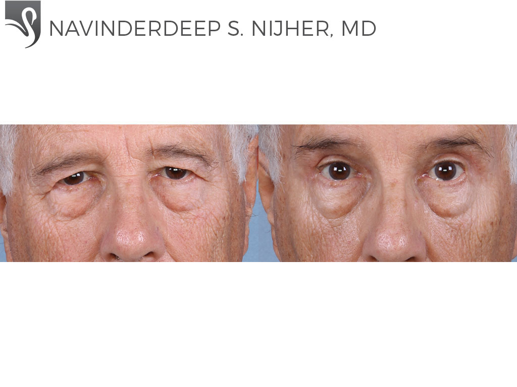 Before and After Image: Eyelid Surgery Case #65097 - front