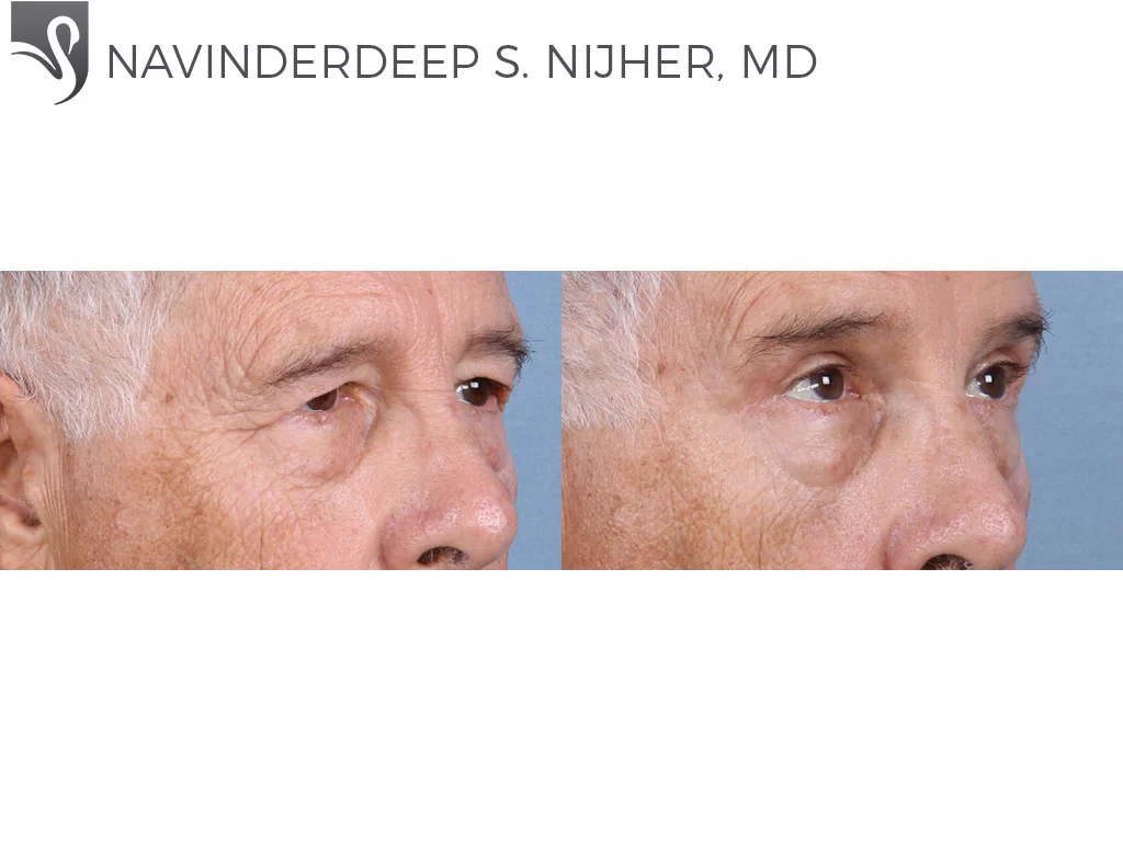 Before and After Image: Eyelid Surgery Case #65097 - right-front-oblique