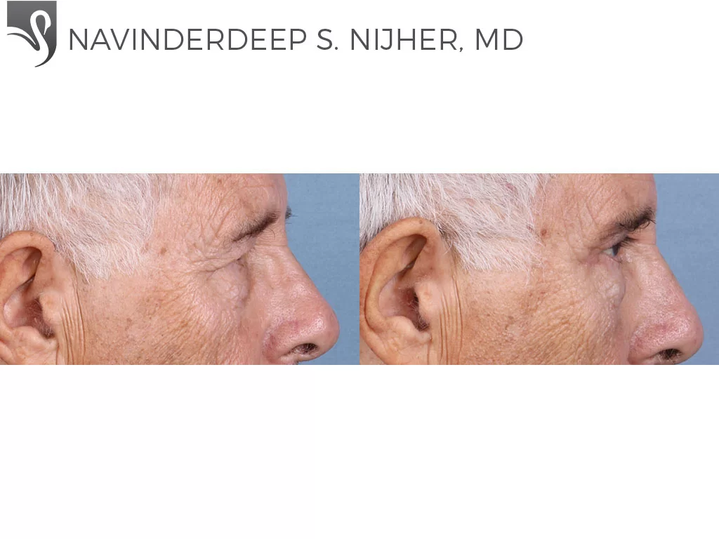Before and After Image: Eyelid Surgery Case #65097 - right-side