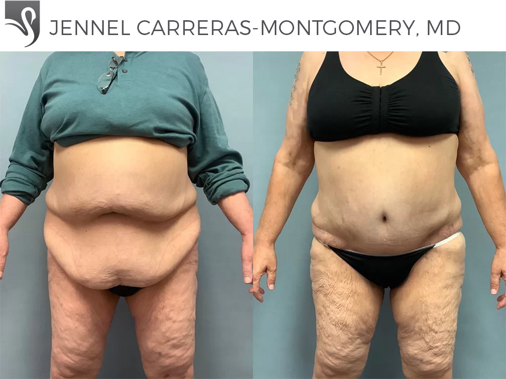Before and After Image: Post-Bariatric Surgery Case #65383