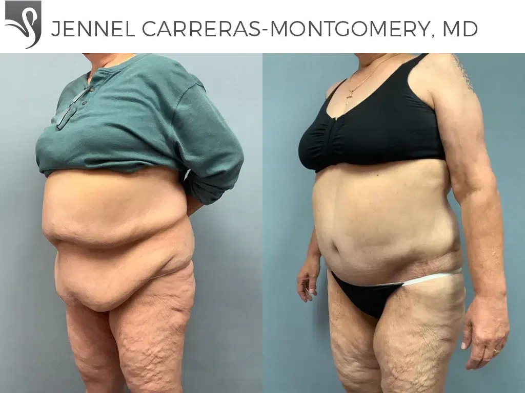 Before and After Image: Post-Bariatric Surgery Case #65383 - left-front-oblique