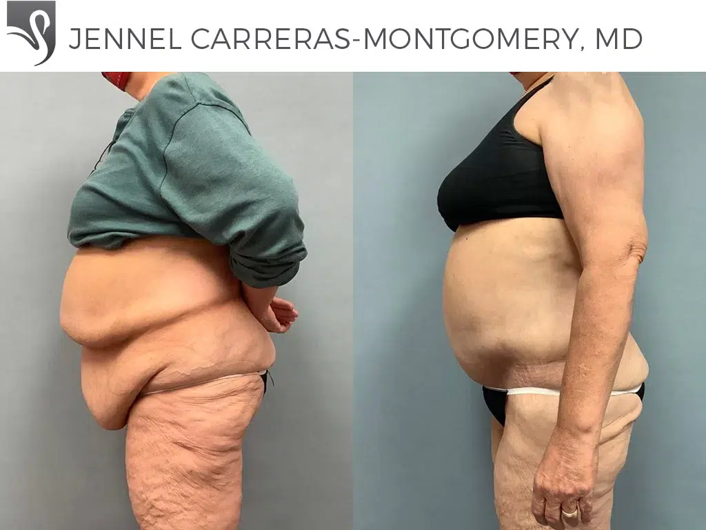 Before and After Image: Post-Bariatric Surgery Case #65383 - left-side