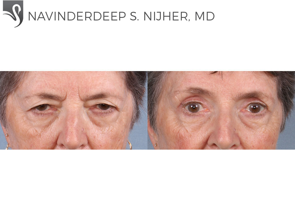 Before and After Image: Eyelid Surgery Case #65395 - front