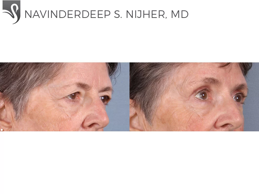Before and After Image: Eyelid Surgery Case #65395 - right-front-oblique