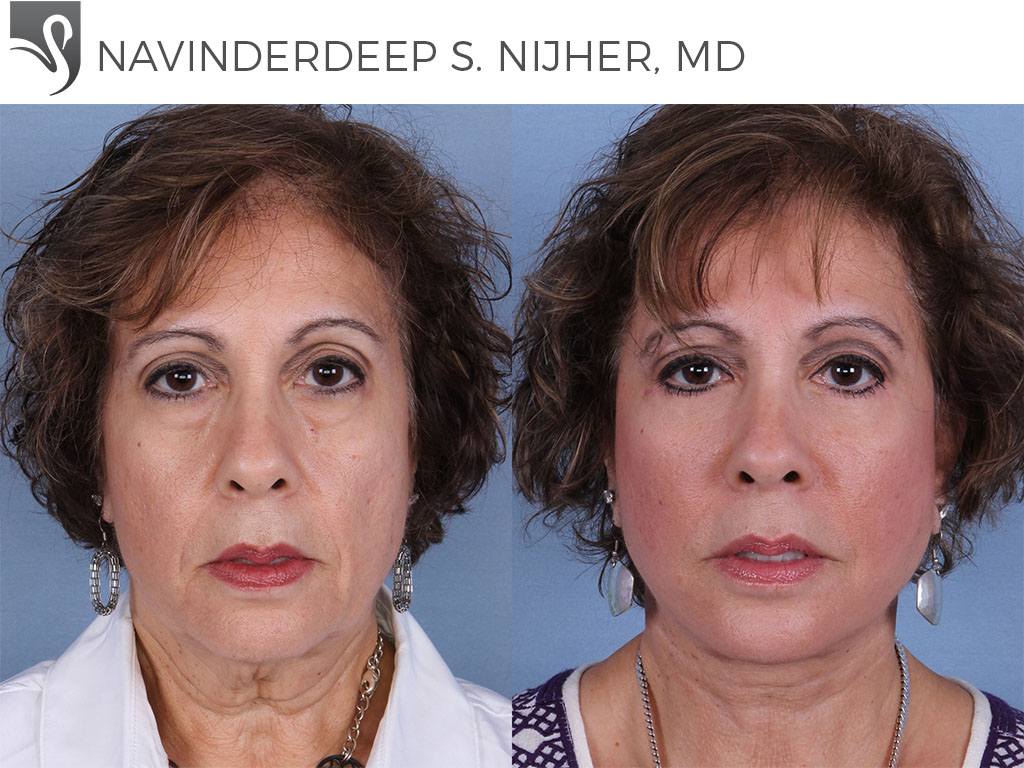 Before and After Image: Face Lift Case #66562 - front
