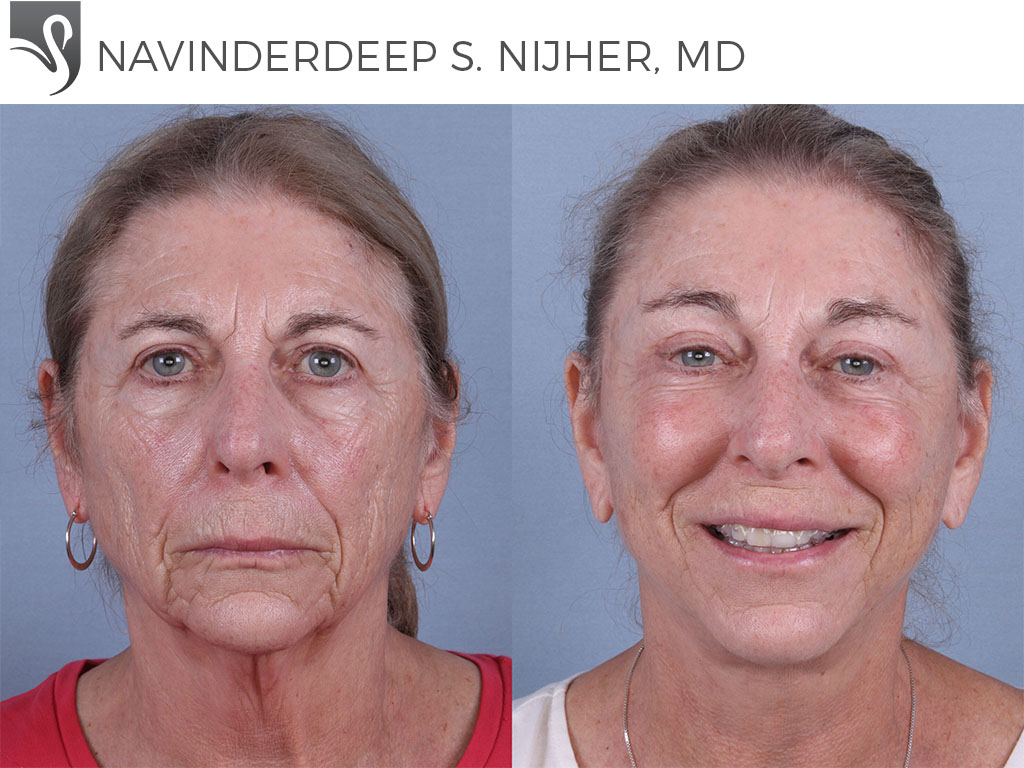 Before and After Image: Face Lift Case #65851 - front
