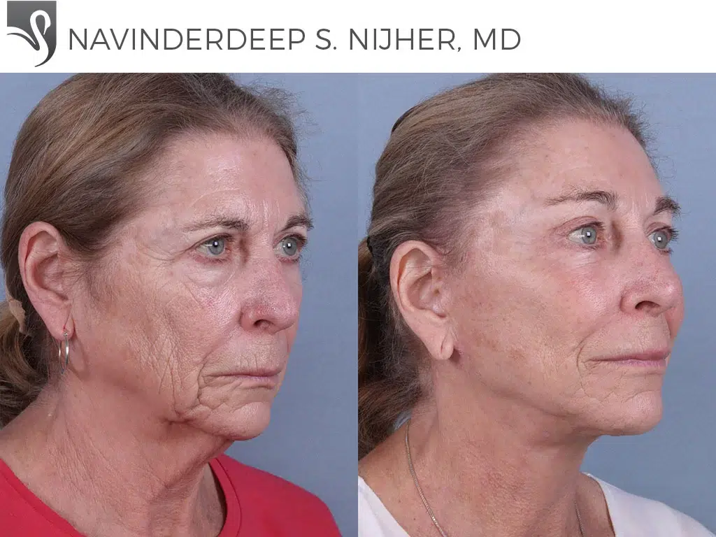 Before and After Image: Face Lift Case #65851 - right-front-oblique