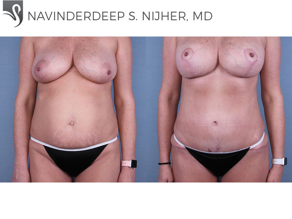 Before and After Image: Abdominoplasty (Tummy Tuck) Case #65911 - front