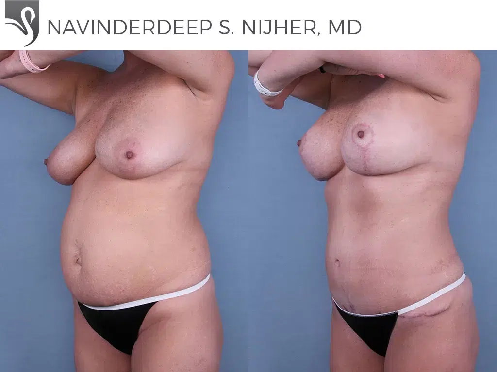 Before and After Image: Mommy Makeover Case #65911 - left-front-oblique