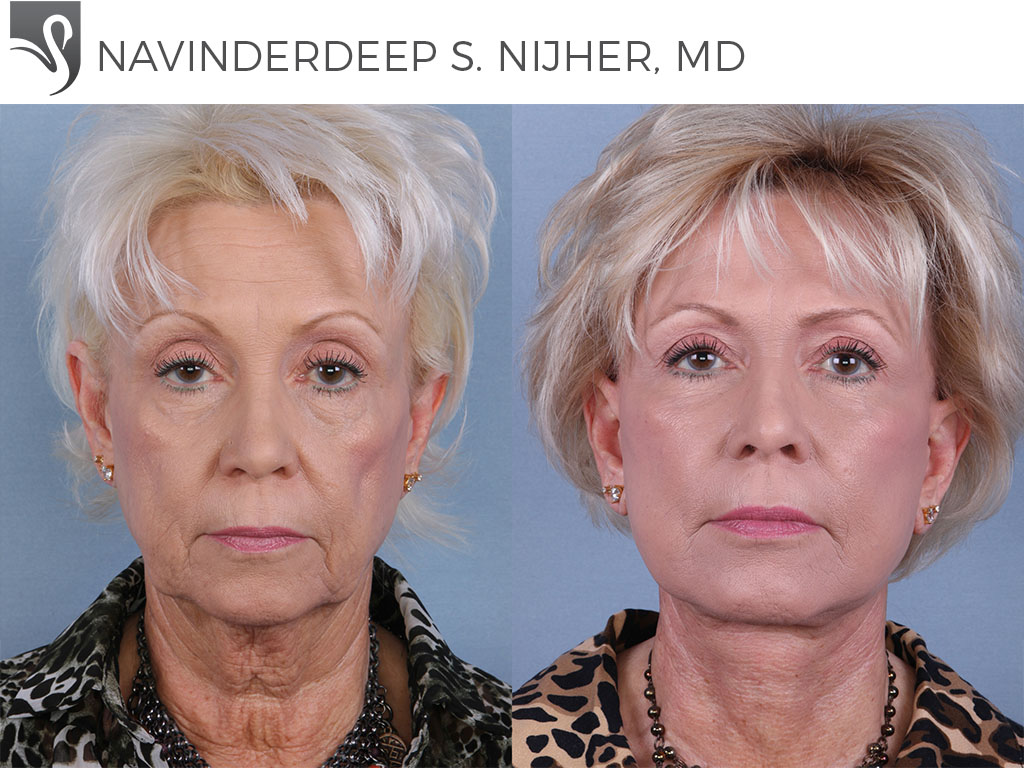 Before and After Image: Face Lift Case #66034 - front