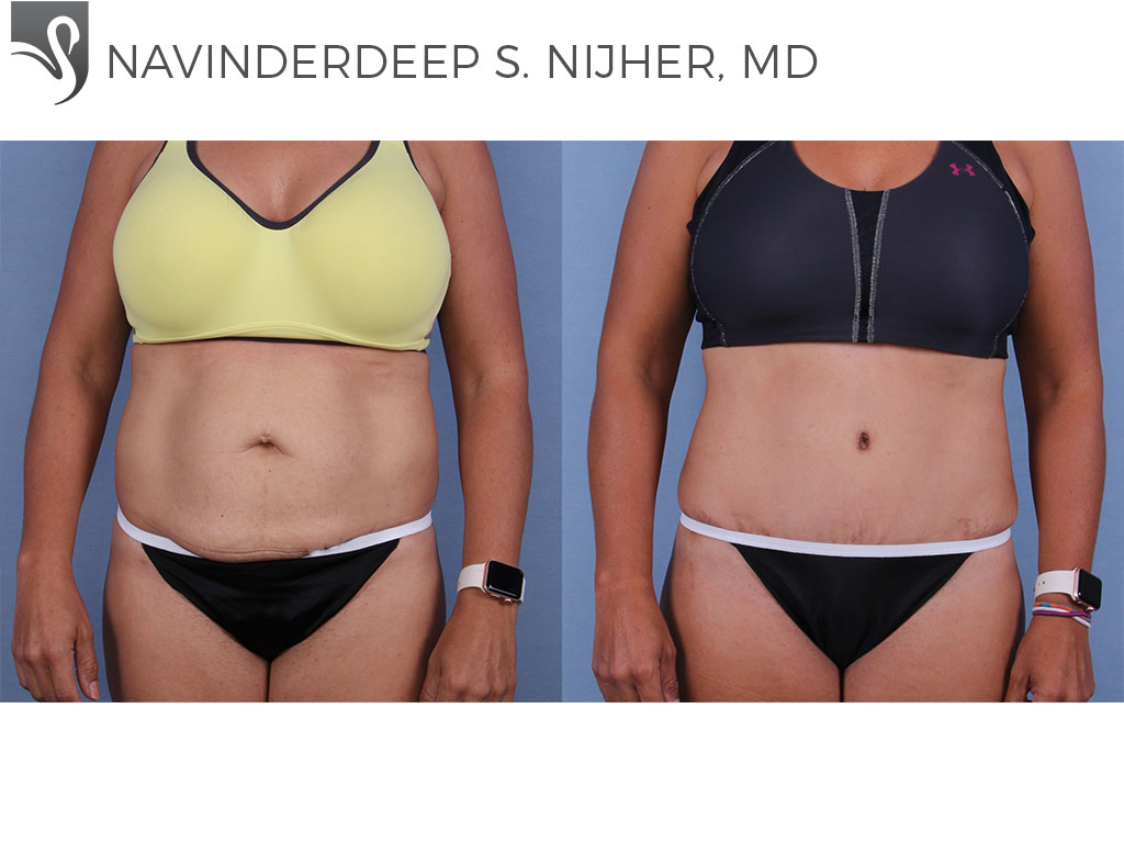 Before and After Image: Abdominoplasty (Tummy Tuck) Case #66157 - front