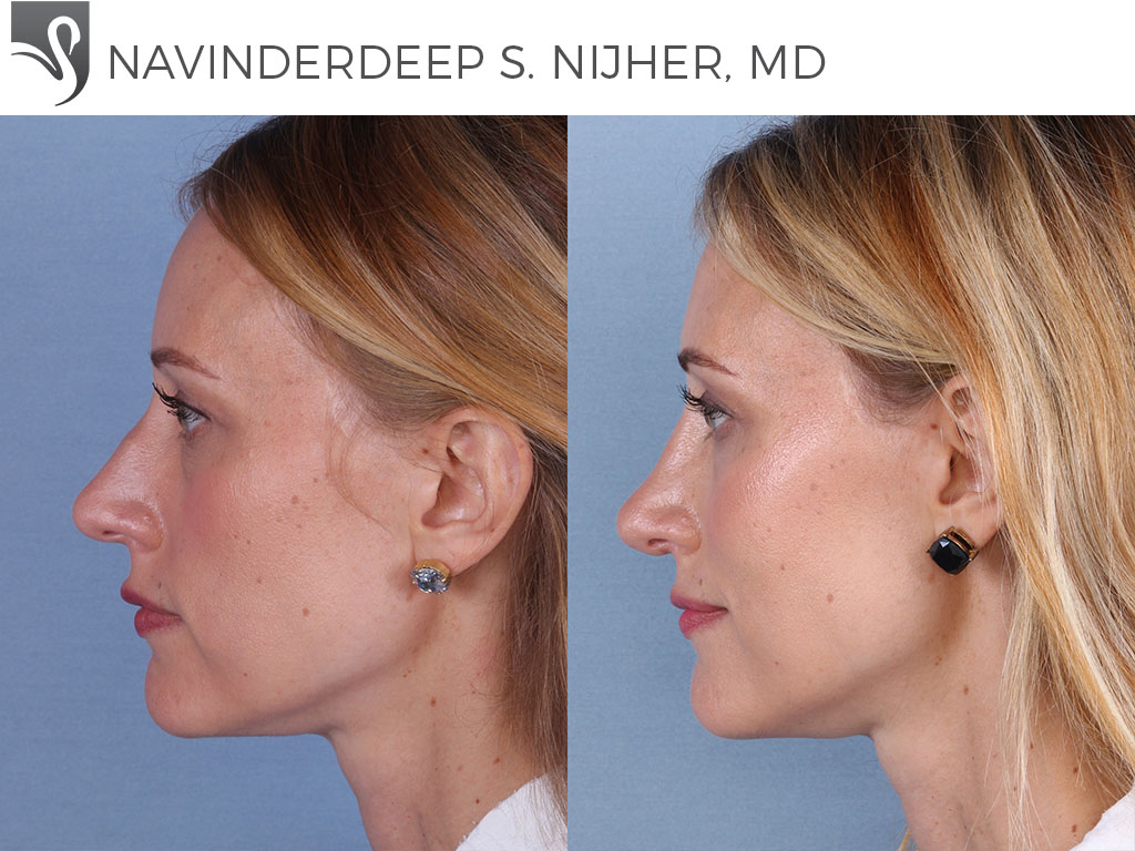 Before and After Image: Rhinoplasty Case #66192
