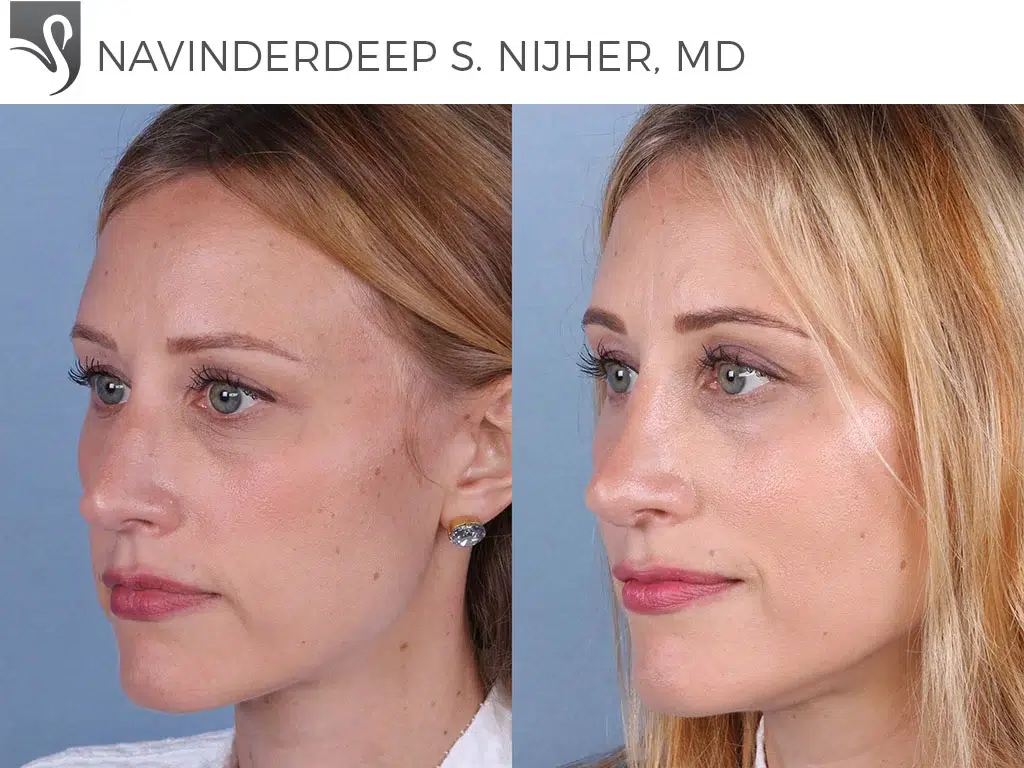 Before and After Image: Rhinoplasty Case #66192 - left-front-oblique