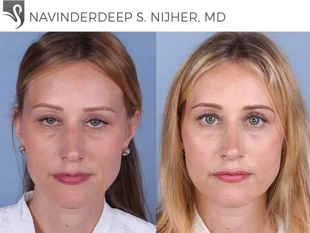 Before and After Image: Rhinoplasty Case #66192 - front