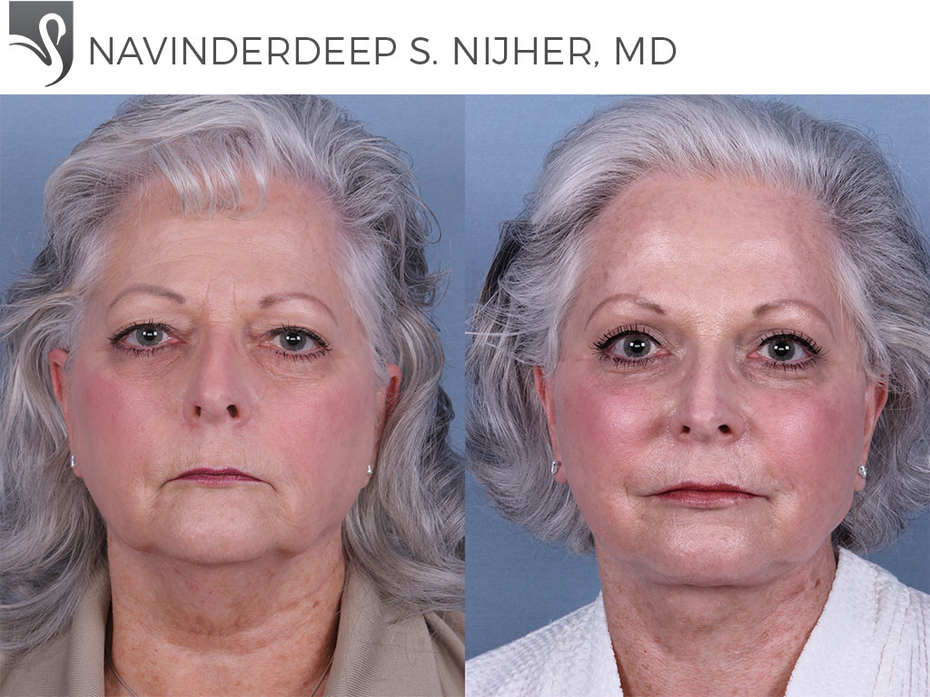 Before and After Image: Face Lift Case #66551 - front