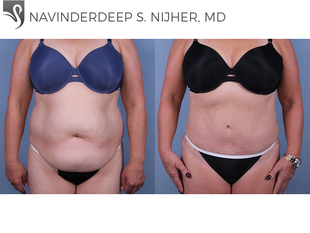 Before and After Image: Abdominoplasty (Tummy Tuck) Case #66553 - front