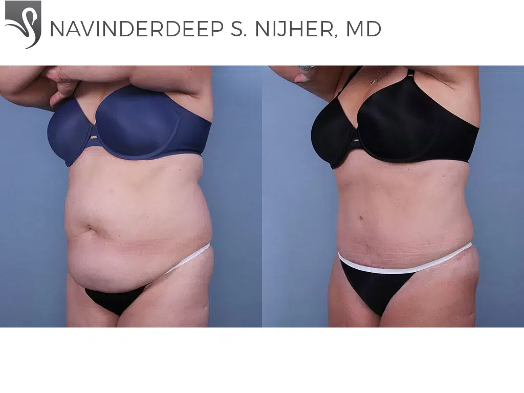 Before and After Image: Abdominoplasty (Tummy Tuck) Case #66553 - left-front-oblique