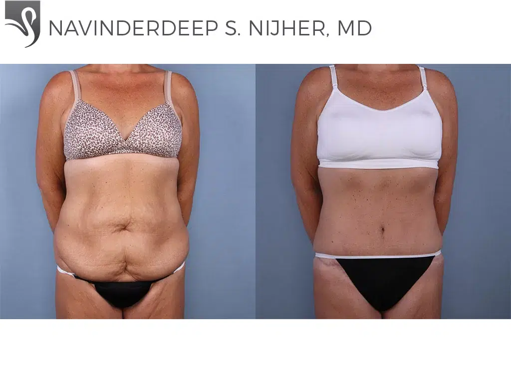 Before and After Image: Abdominoplasty (Tummy Tuck) Case #66622 - front