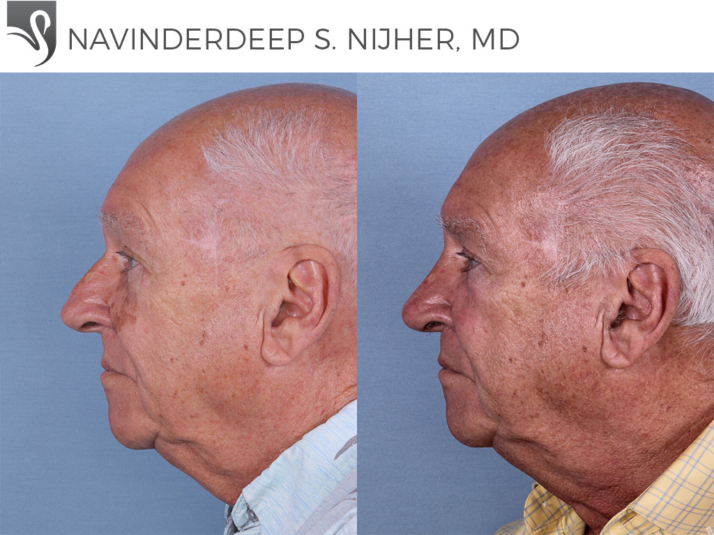 Before and After Image: Rhinoplasty Case #66780 - left-side