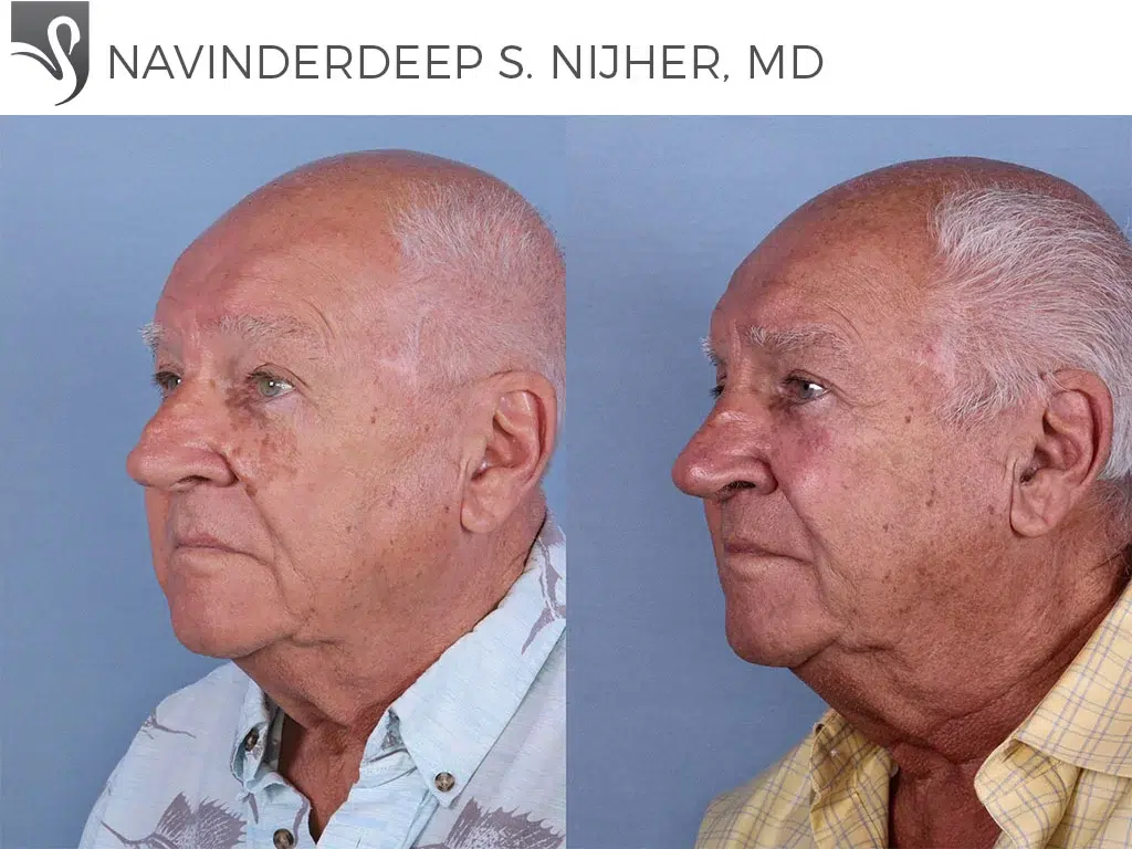 Before and After Image: Rhinoplasty Case #66780 - left-front-oblique