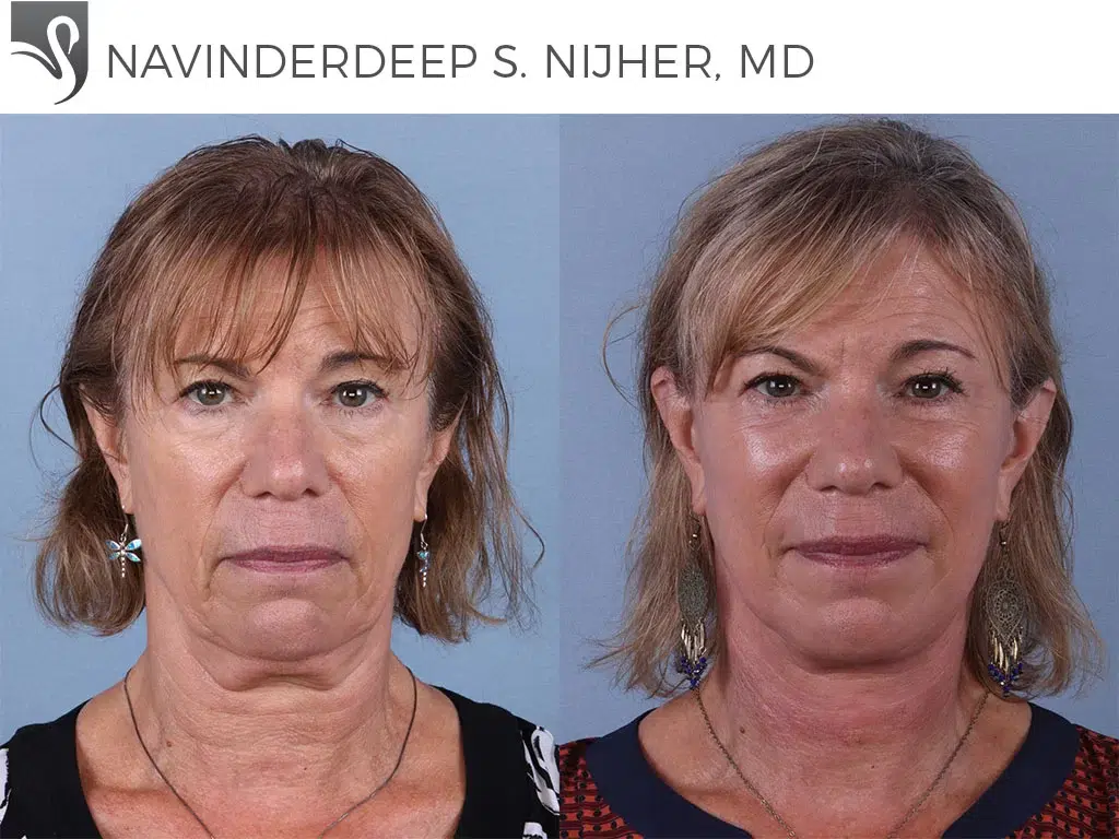 Before and After Image: Face Lift Case #66890 - front