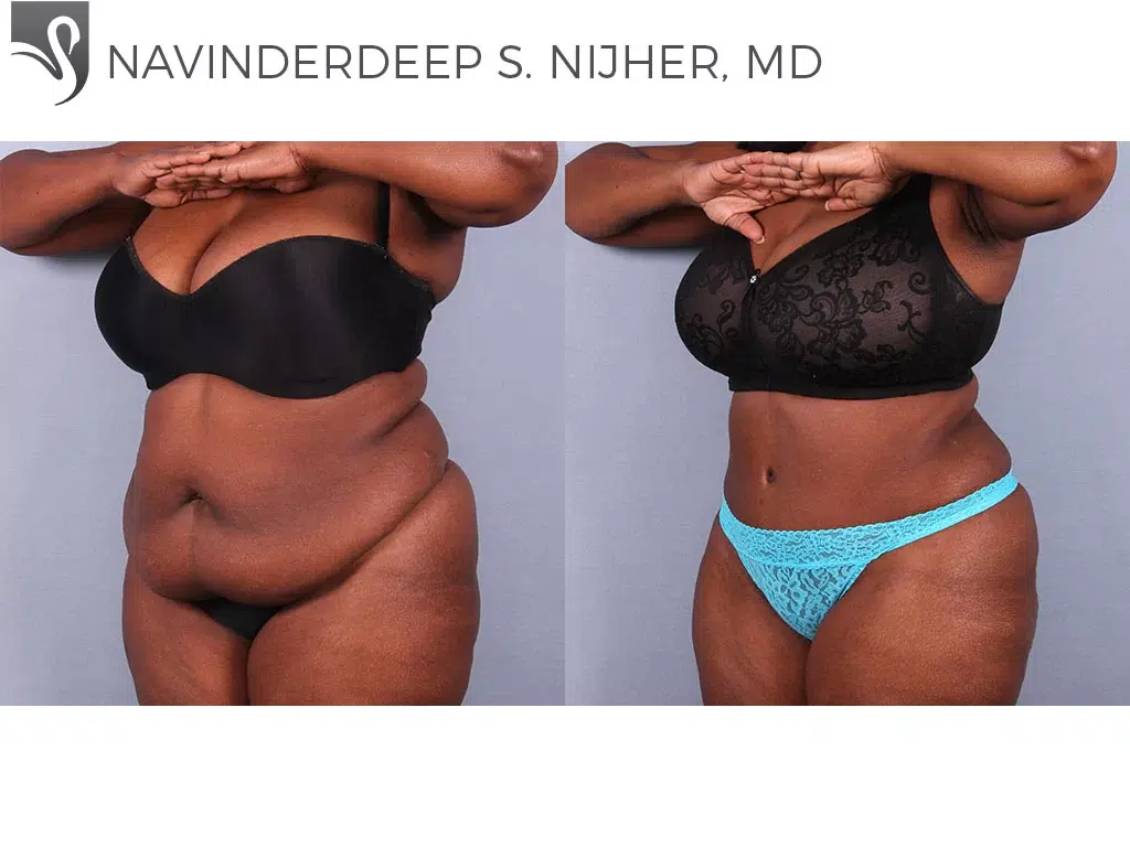 Before and After Image: Abdominoplasty (Tummy Tuck) Case #67097 - left-front-oblique