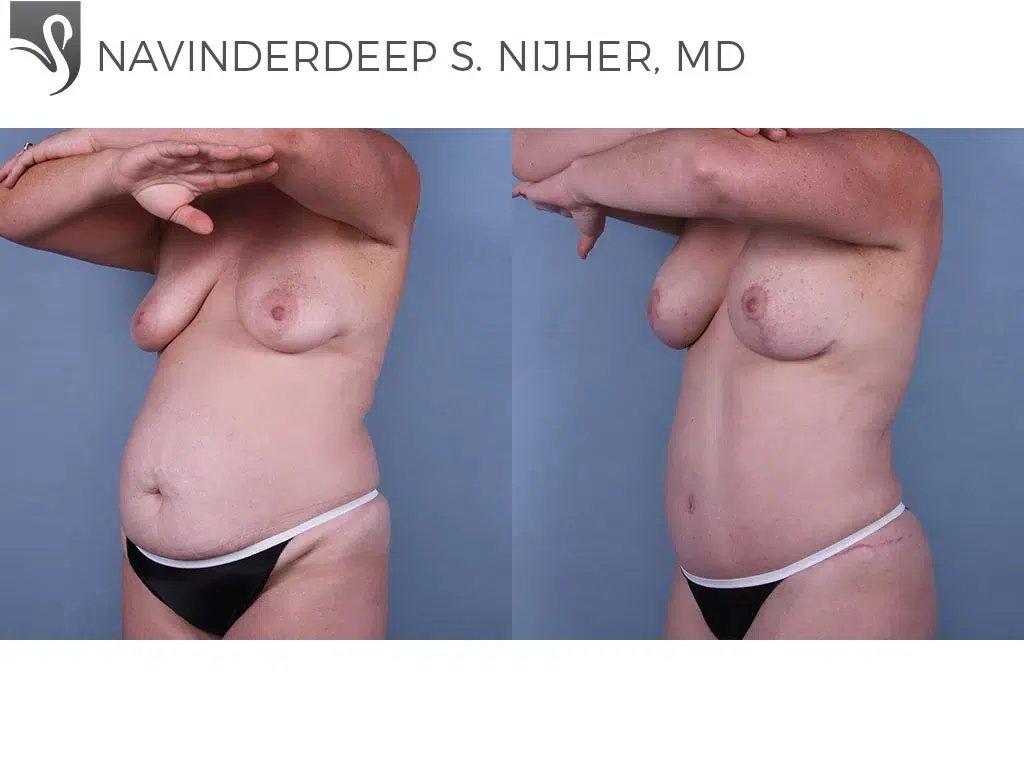 Before and After Image: Mommy Makeover Case #67115 - left-front-oblique
