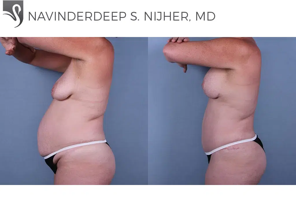 Before and After Image: Mommy Makeover Case #67115 - left-side