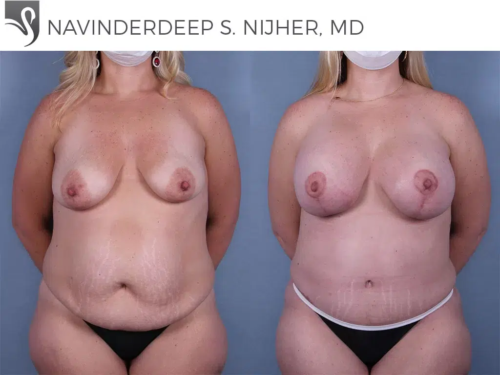 Before and After Image: Mommy Makeover Case #67121 - front