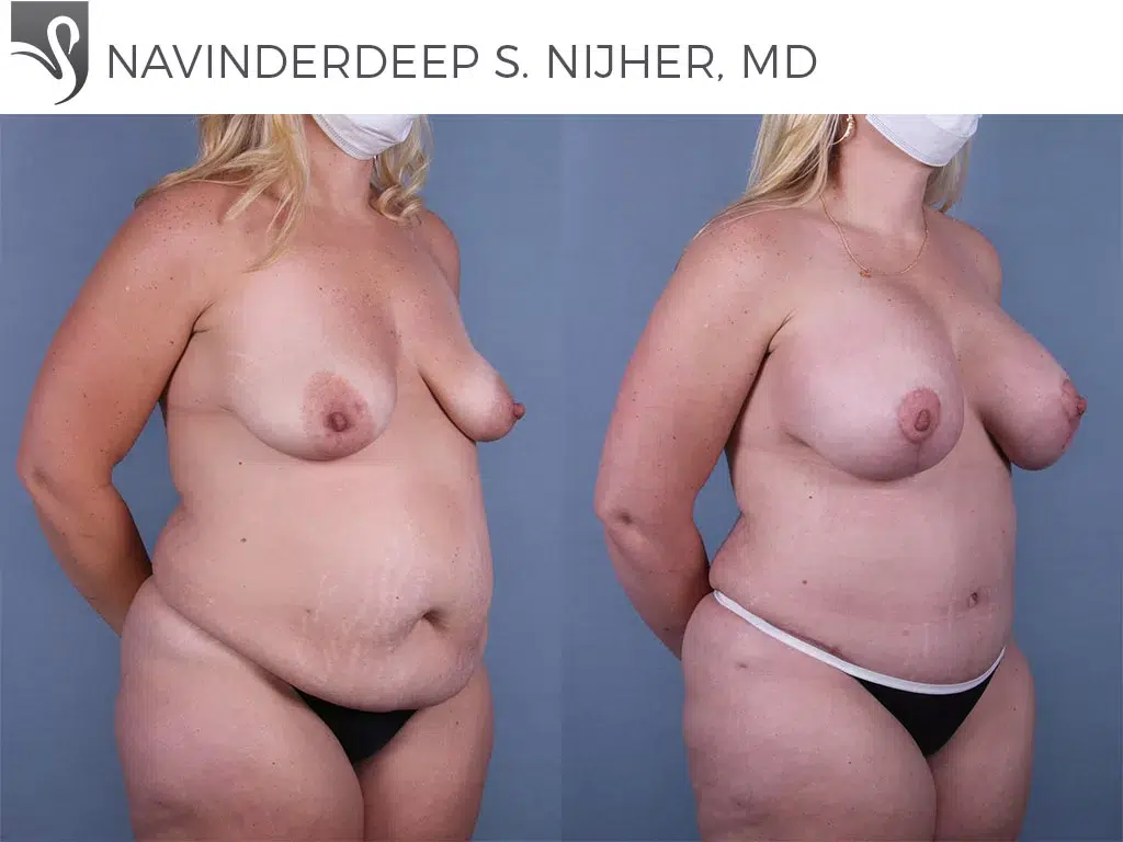 Before and After Image: Mommy Makeover Case #67121 - right-front-oblique
