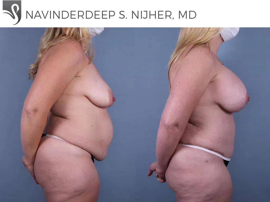 Before and After Image: Mommy Makeover Case #67121 - right-side