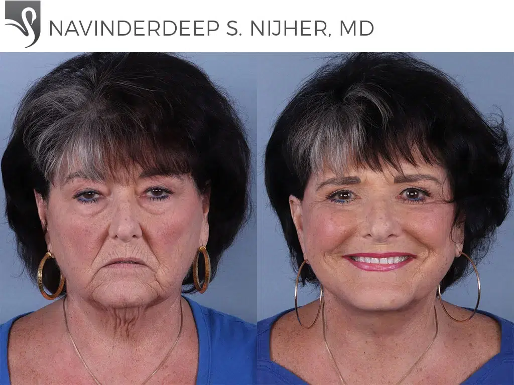 Before and After Image: Face Lift Case #67305 - front