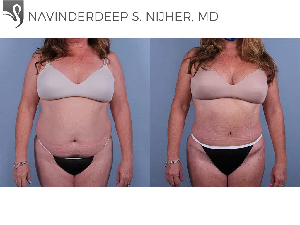 Before and After Image: Abdominoplasty (Tummy Tuck) Case #67391 - front