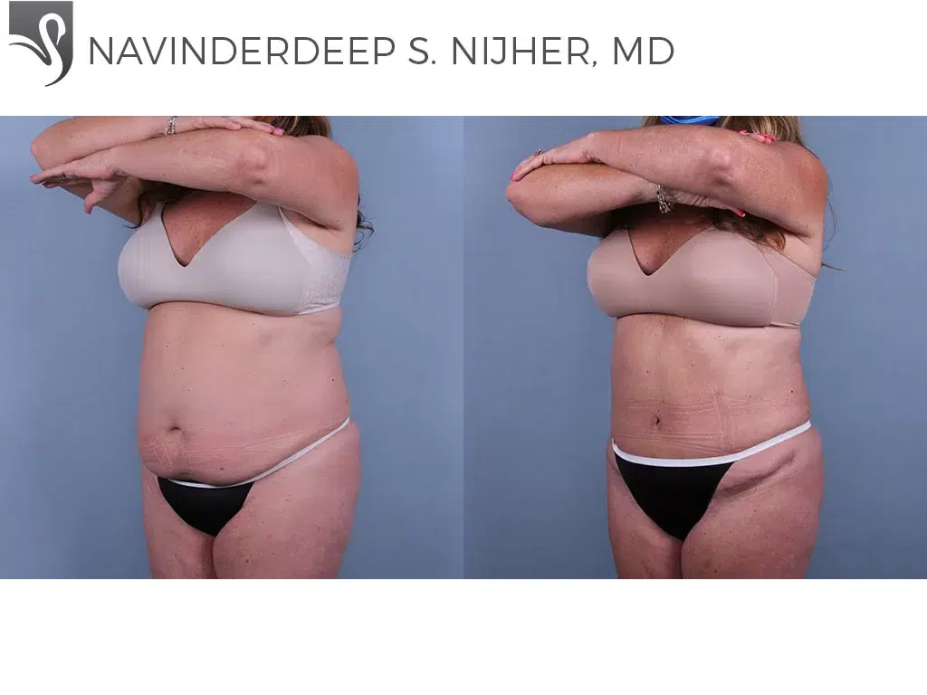 Before and After Image: Abdominoplasty (Tummy Tuck) Case #67391 - left-front-oblique