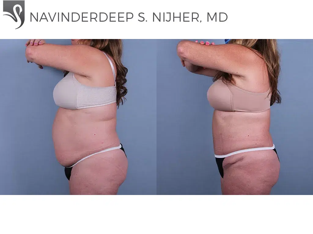 Before and After Image: Abdominoplasty (Tummy Tuck) Case #67391 - left-side