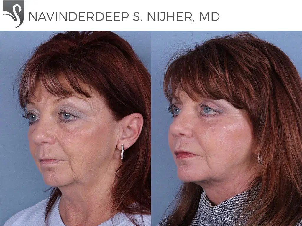 Before and After Image: Face Lift Case #67435 - left-front-oblique